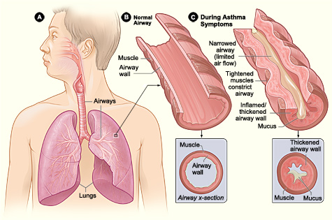 Asthma attack illustration at NHC