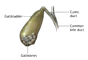 gallbladder stone