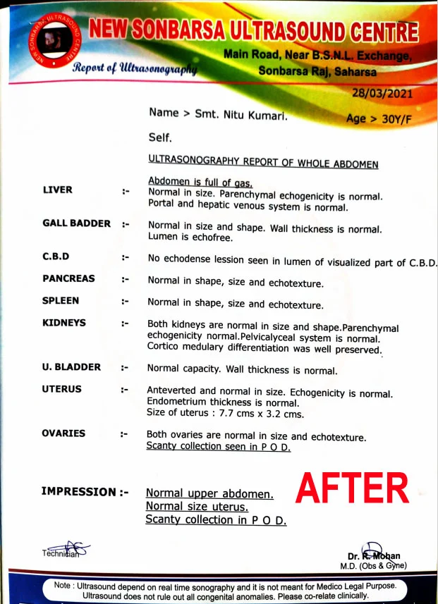 removed gallstones naturally without operation