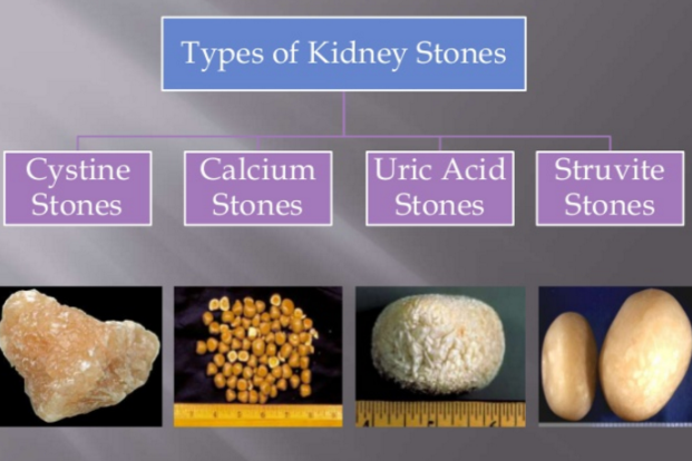 Types of Kidney stone